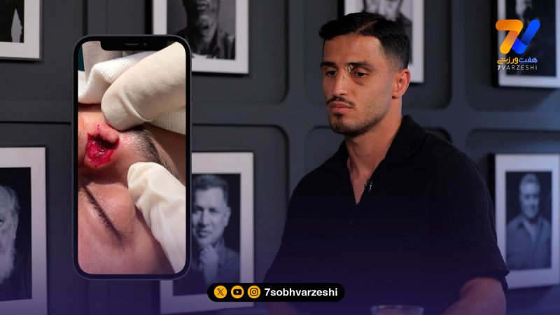 روایت علی علیپور از خطری که از بیخ چشمش گذشت