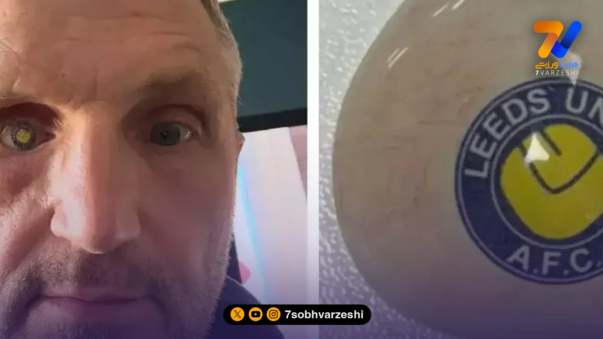 عشق تا ابد به لیدز؛ چشم مصنوعی با نشان باشگاه +عکس